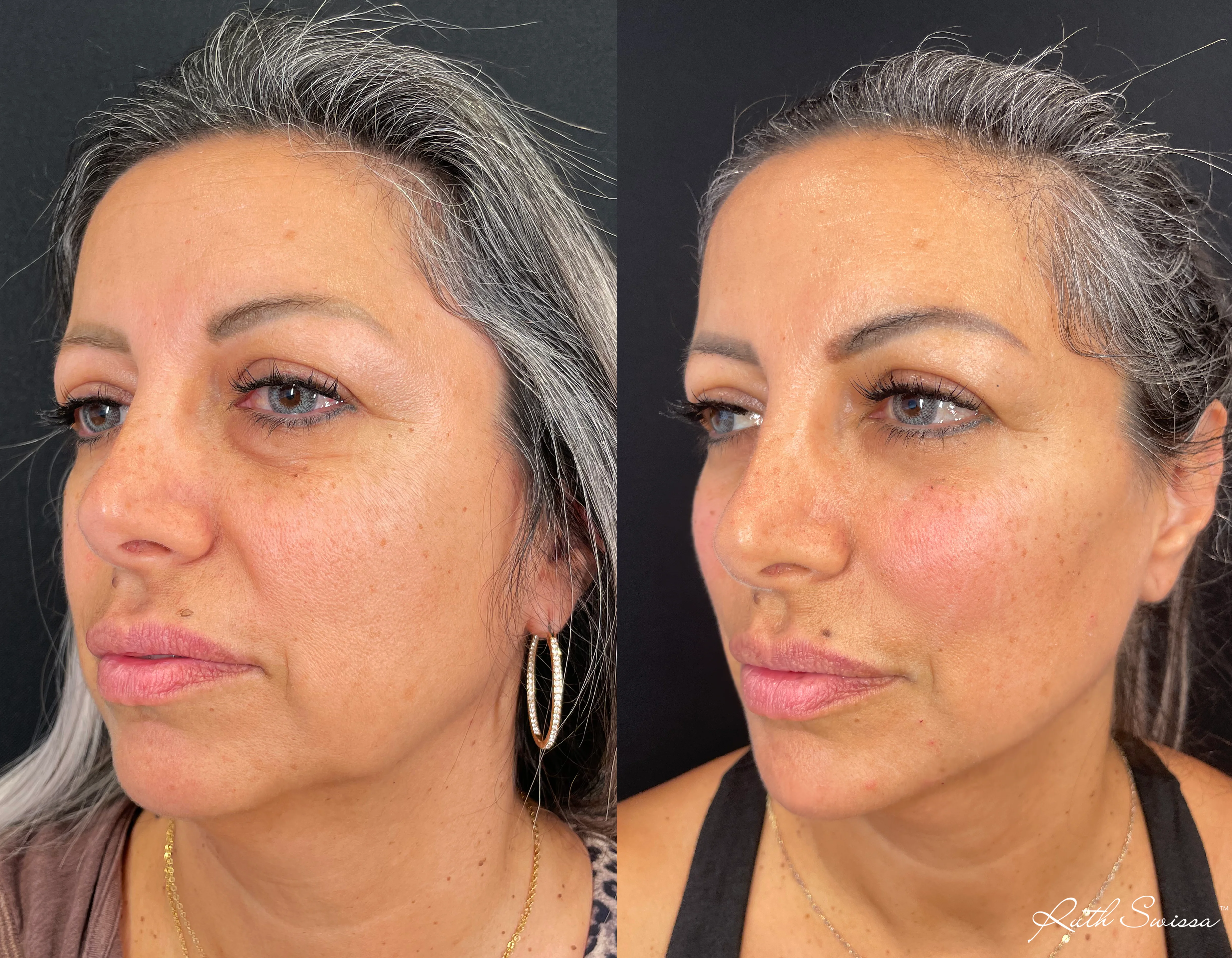 Facial balancing