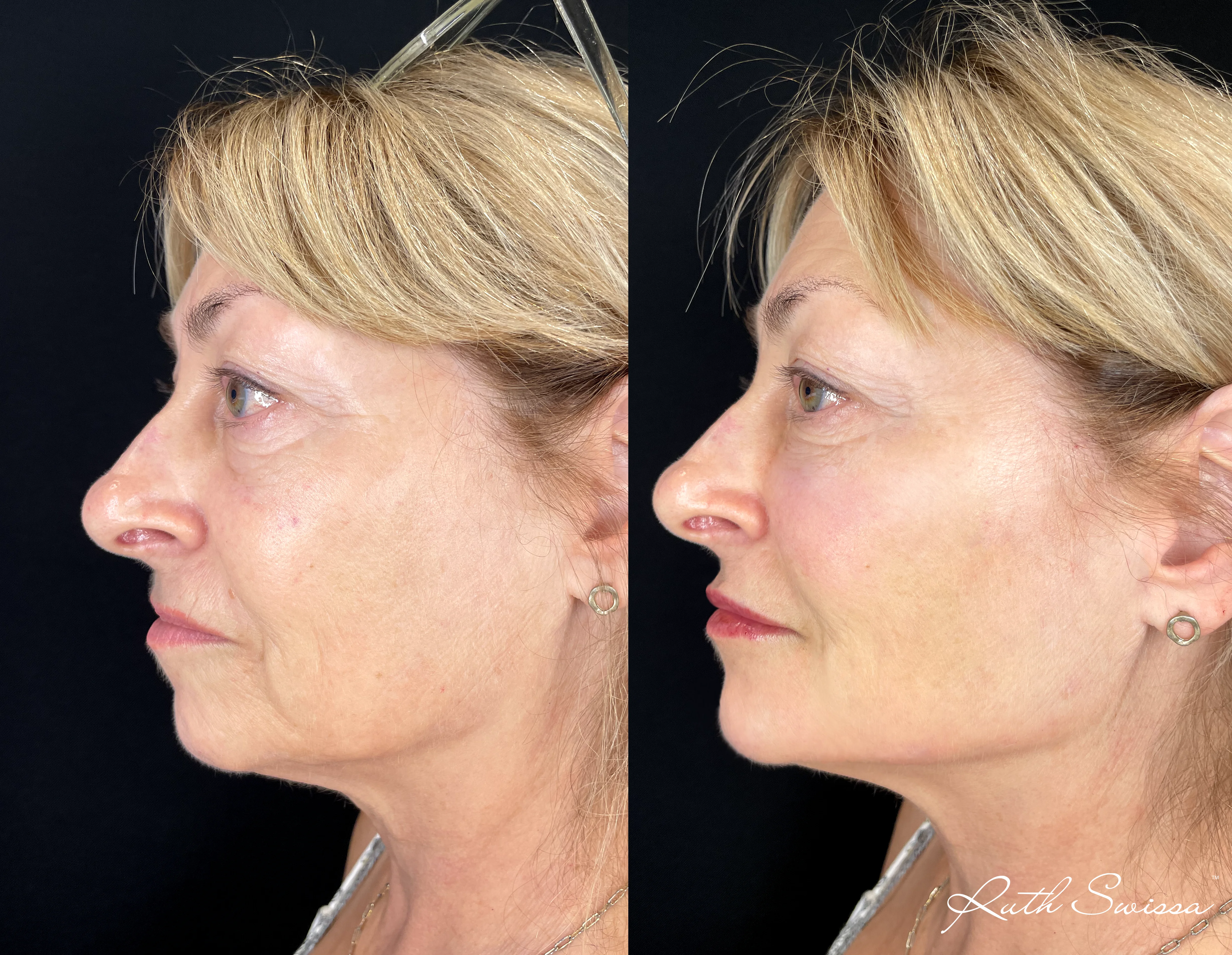 Facial balancing