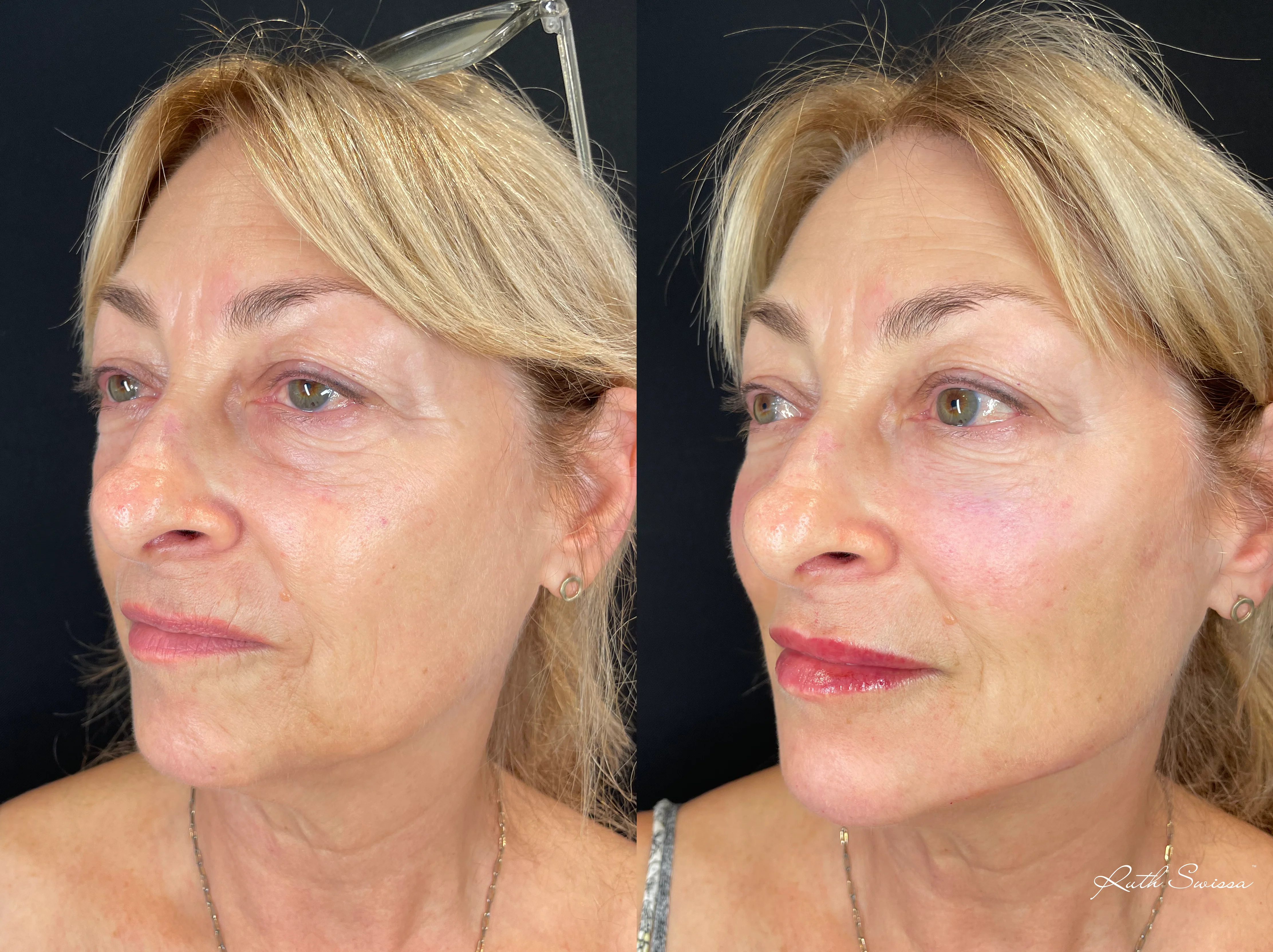 Facial balancing