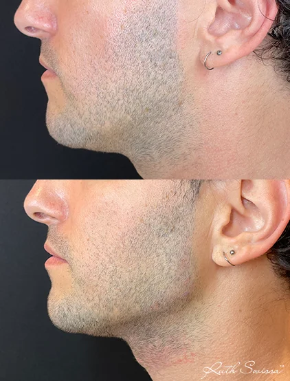 Jawline filler