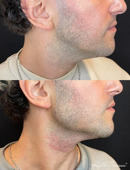 Jawline filler