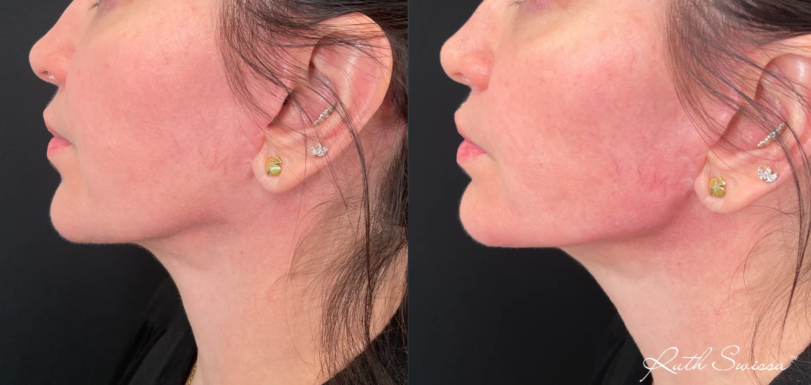Jawline filler