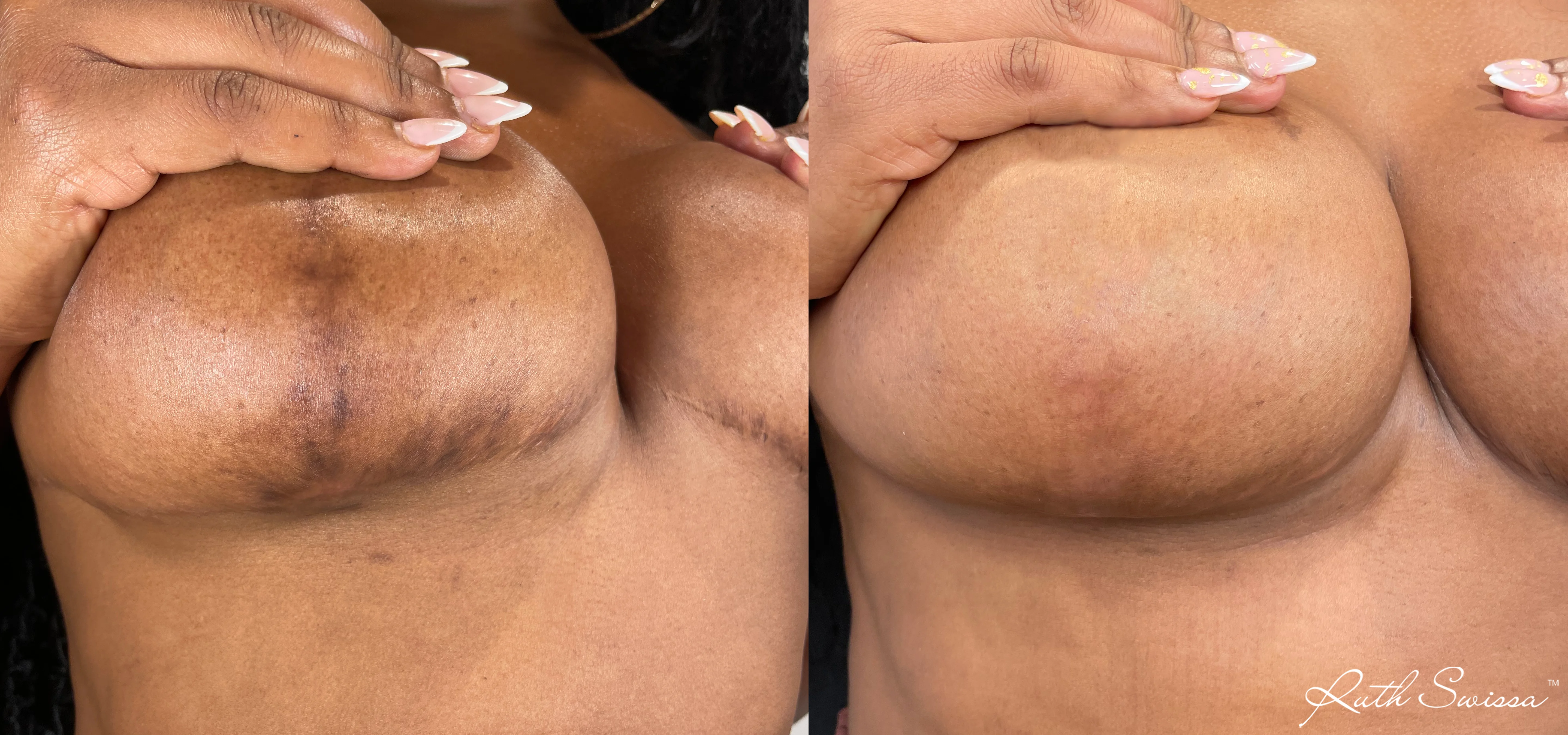 Fractional laser