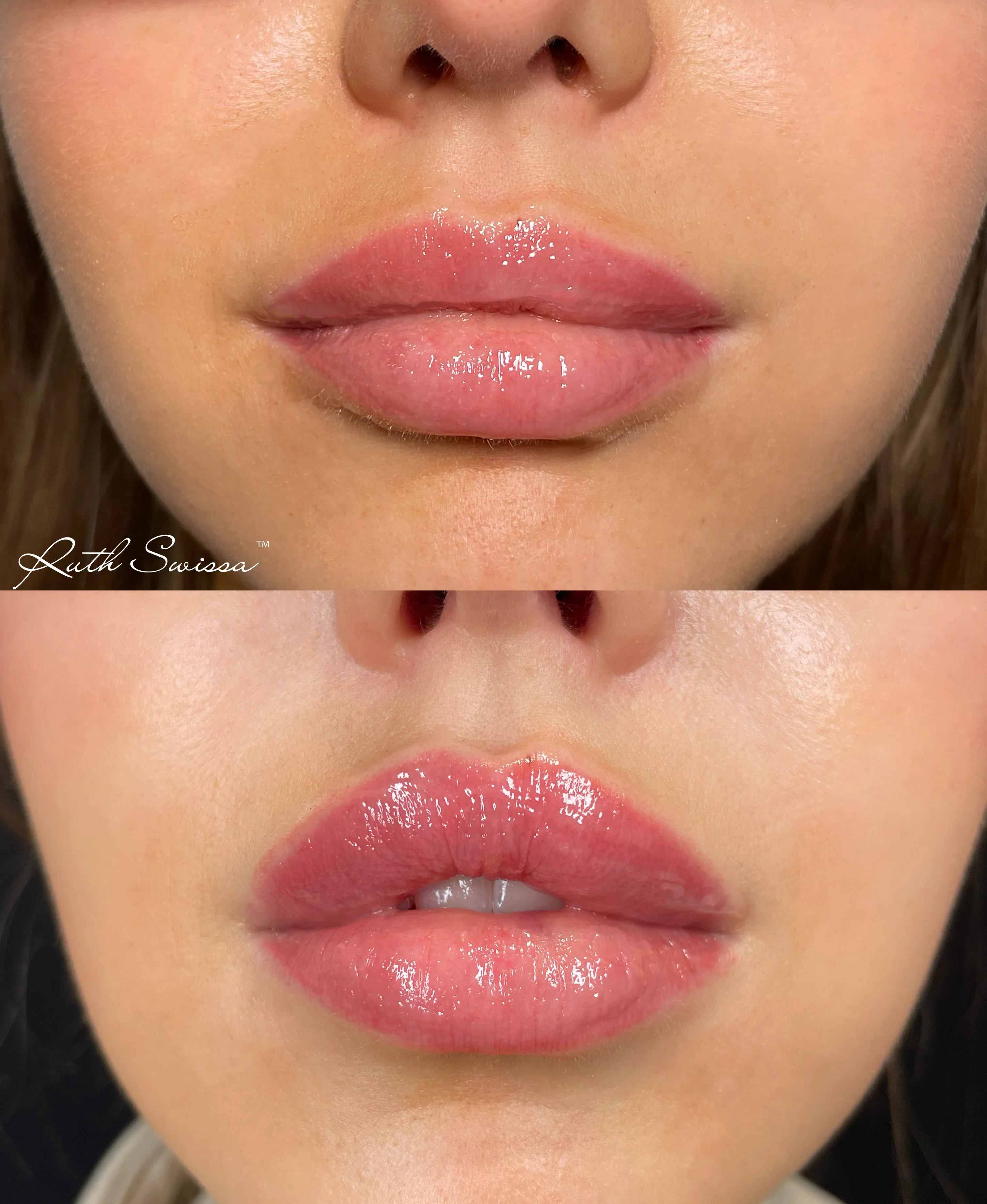 Lip filler