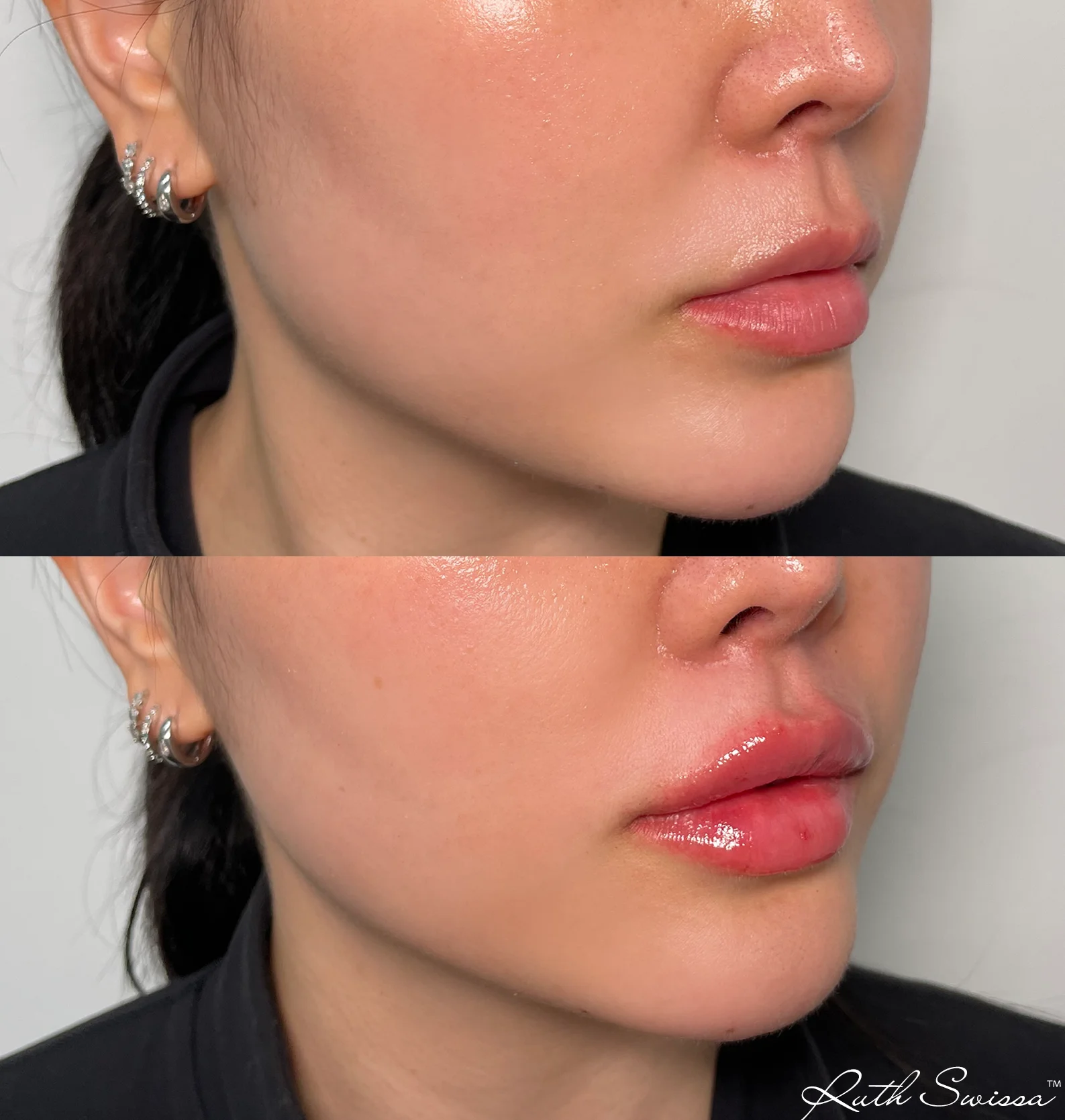 Lip filler