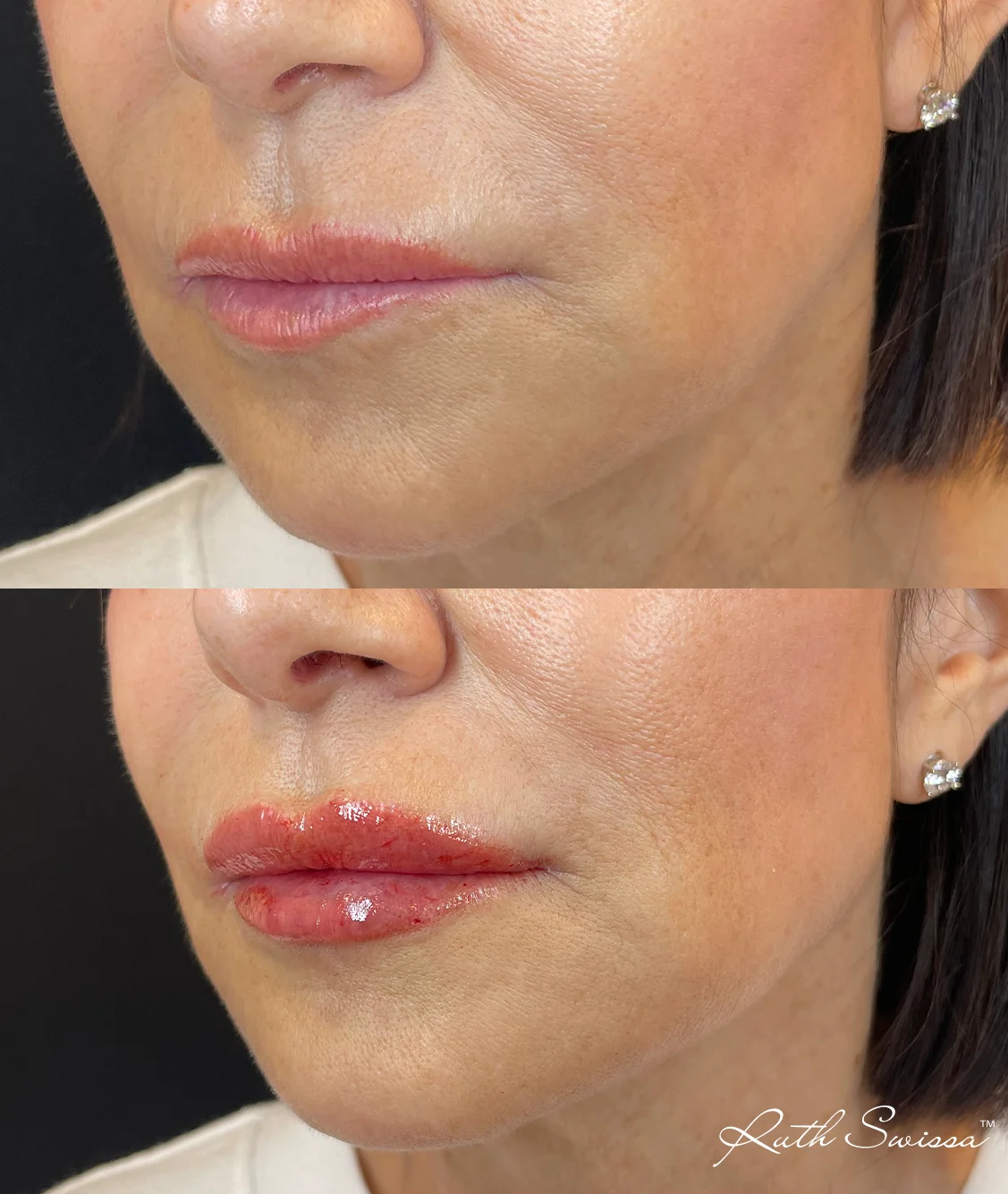 Lip filler