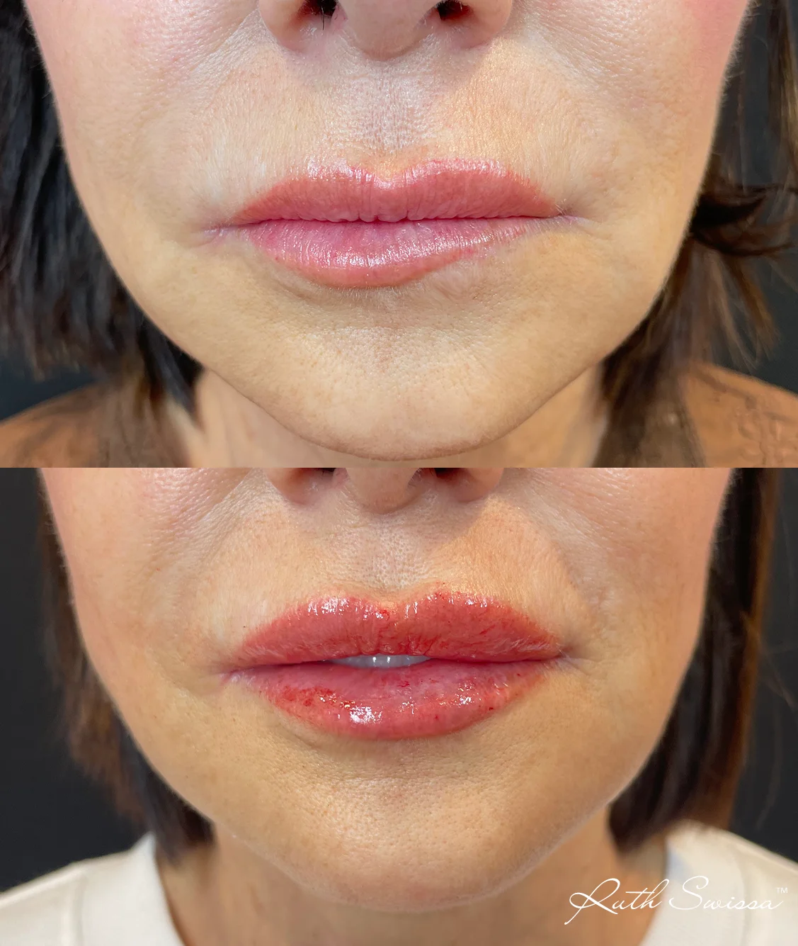 Lip filler