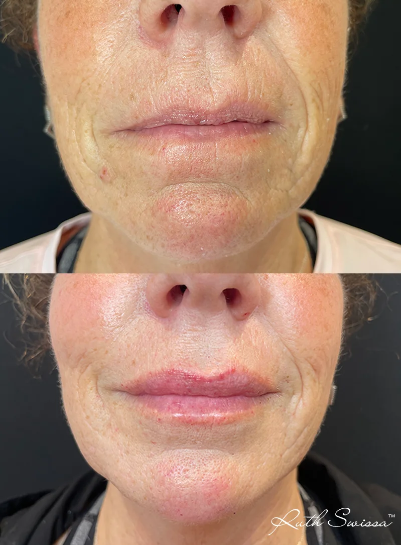 Lip filler