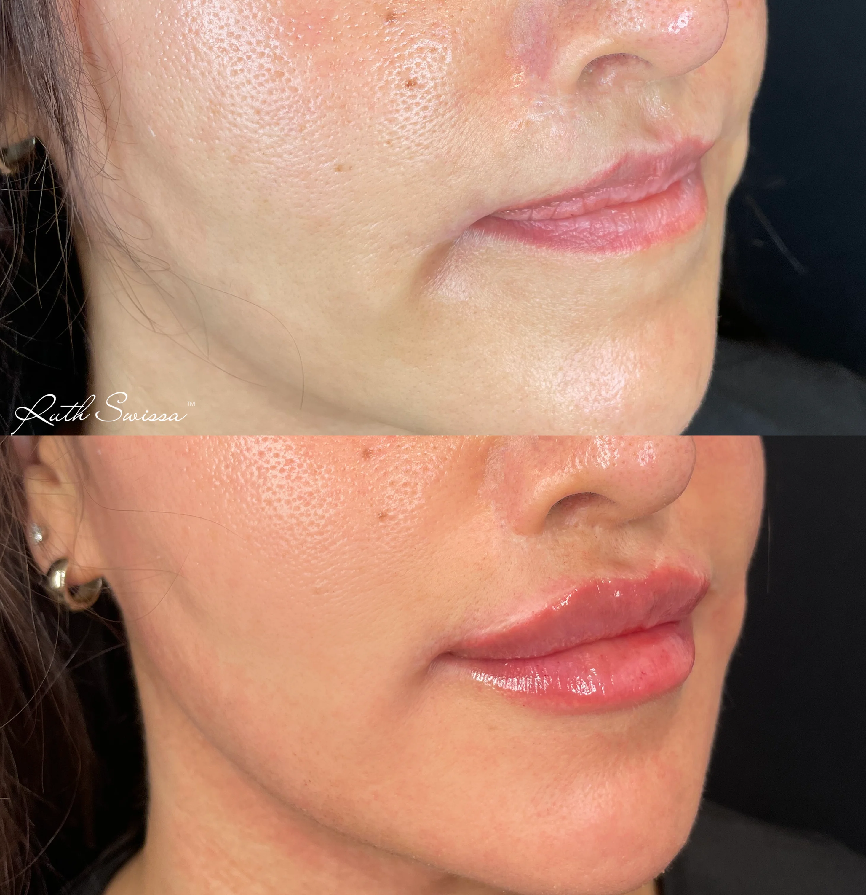 Lip filler