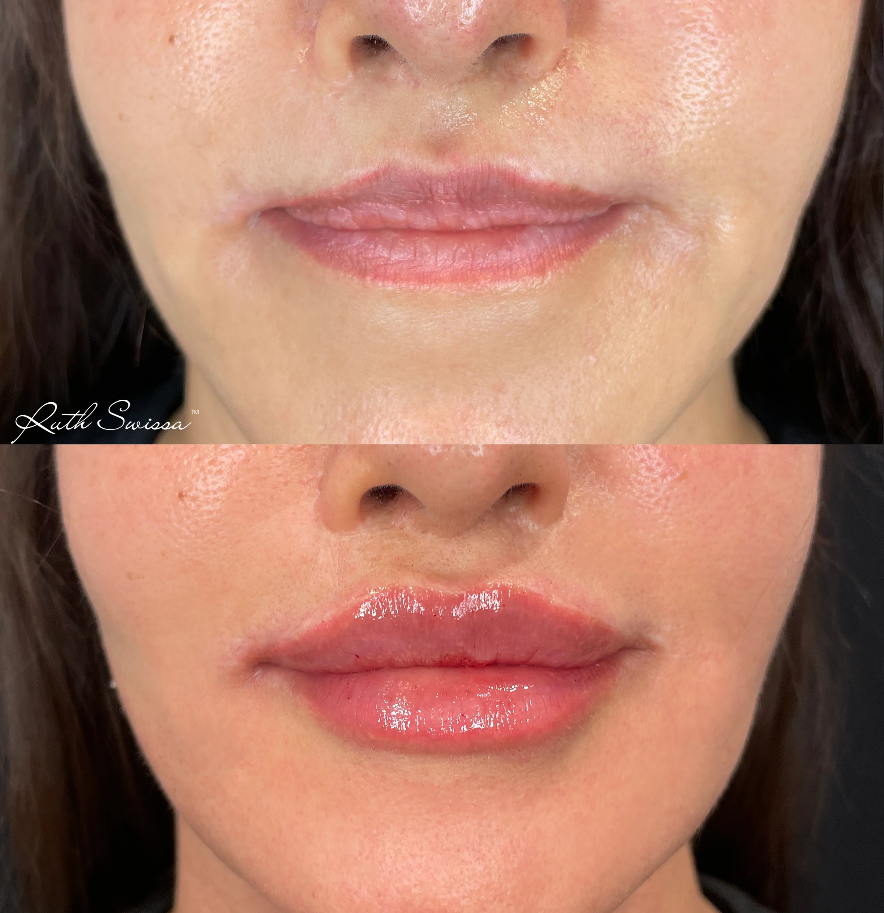 Lip filler