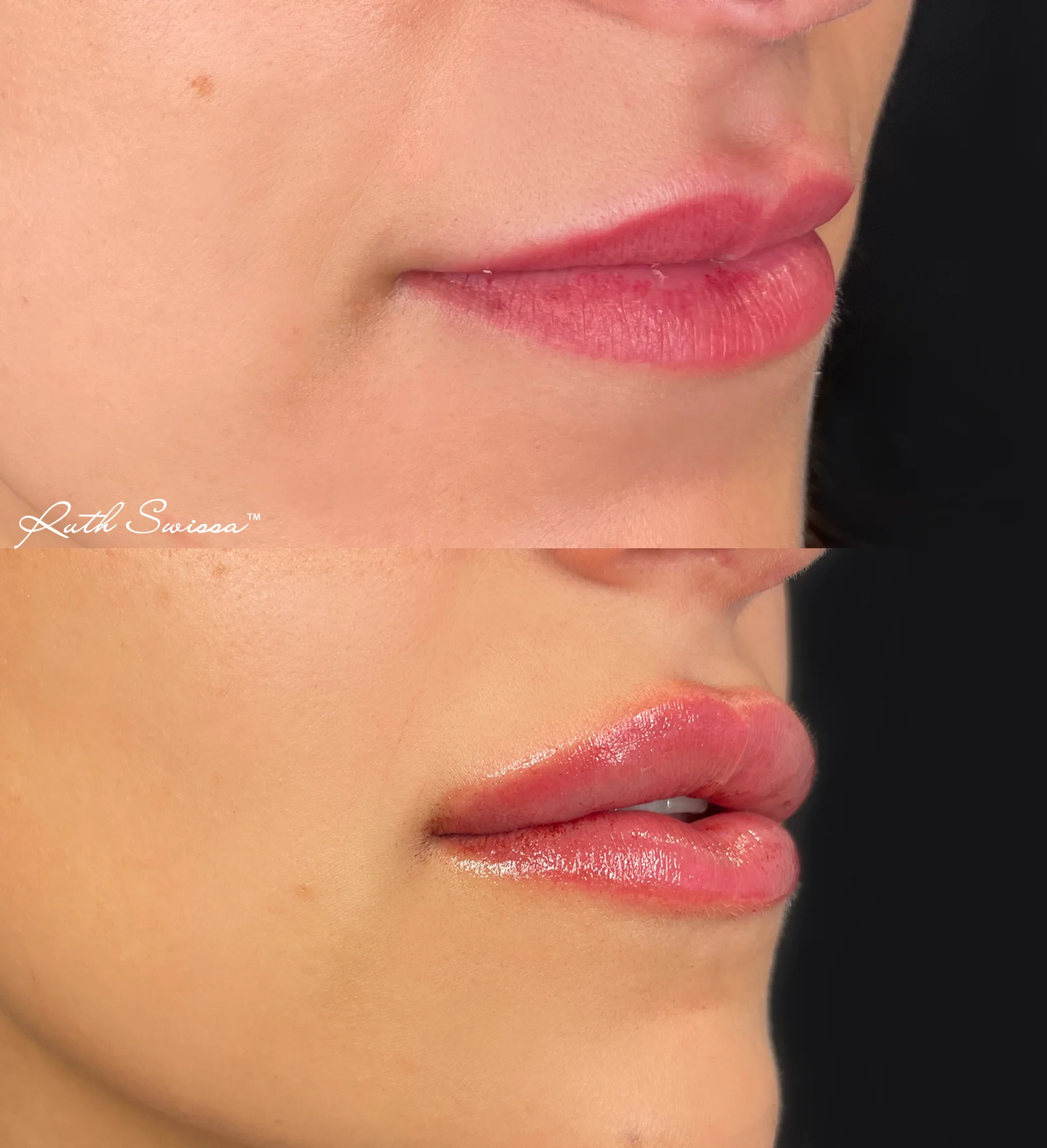 Lip filler