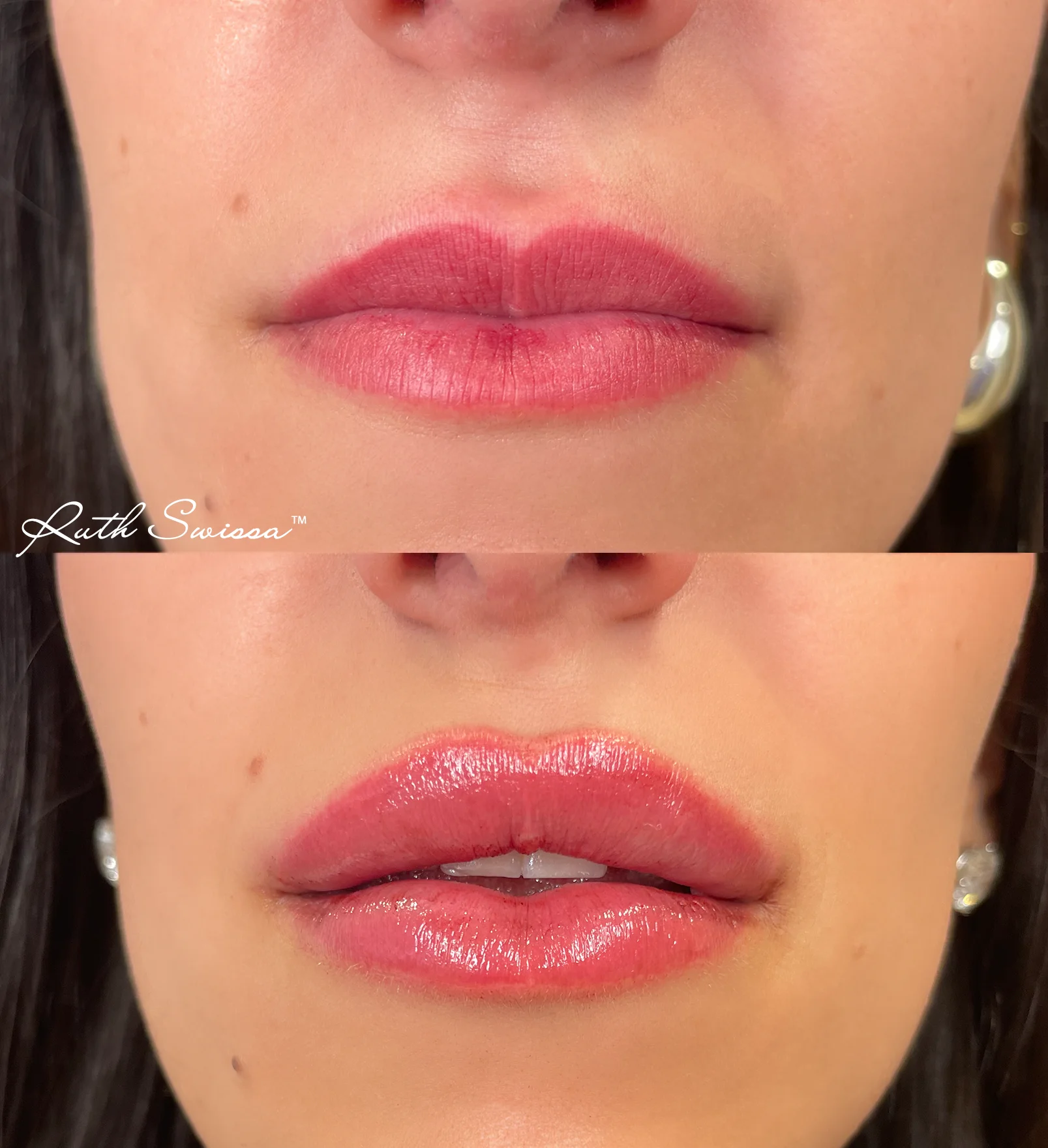 Lip filler