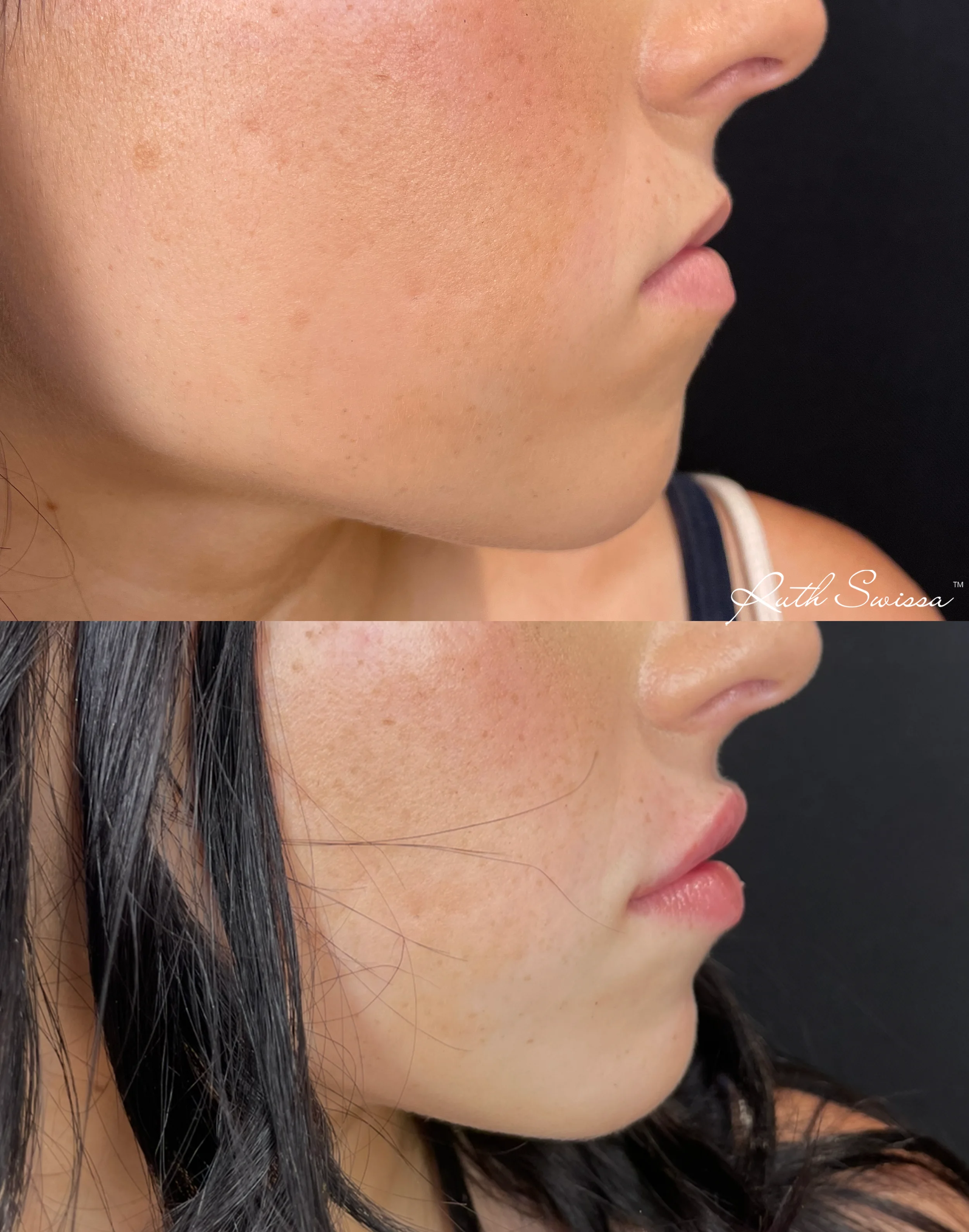 Lip filler