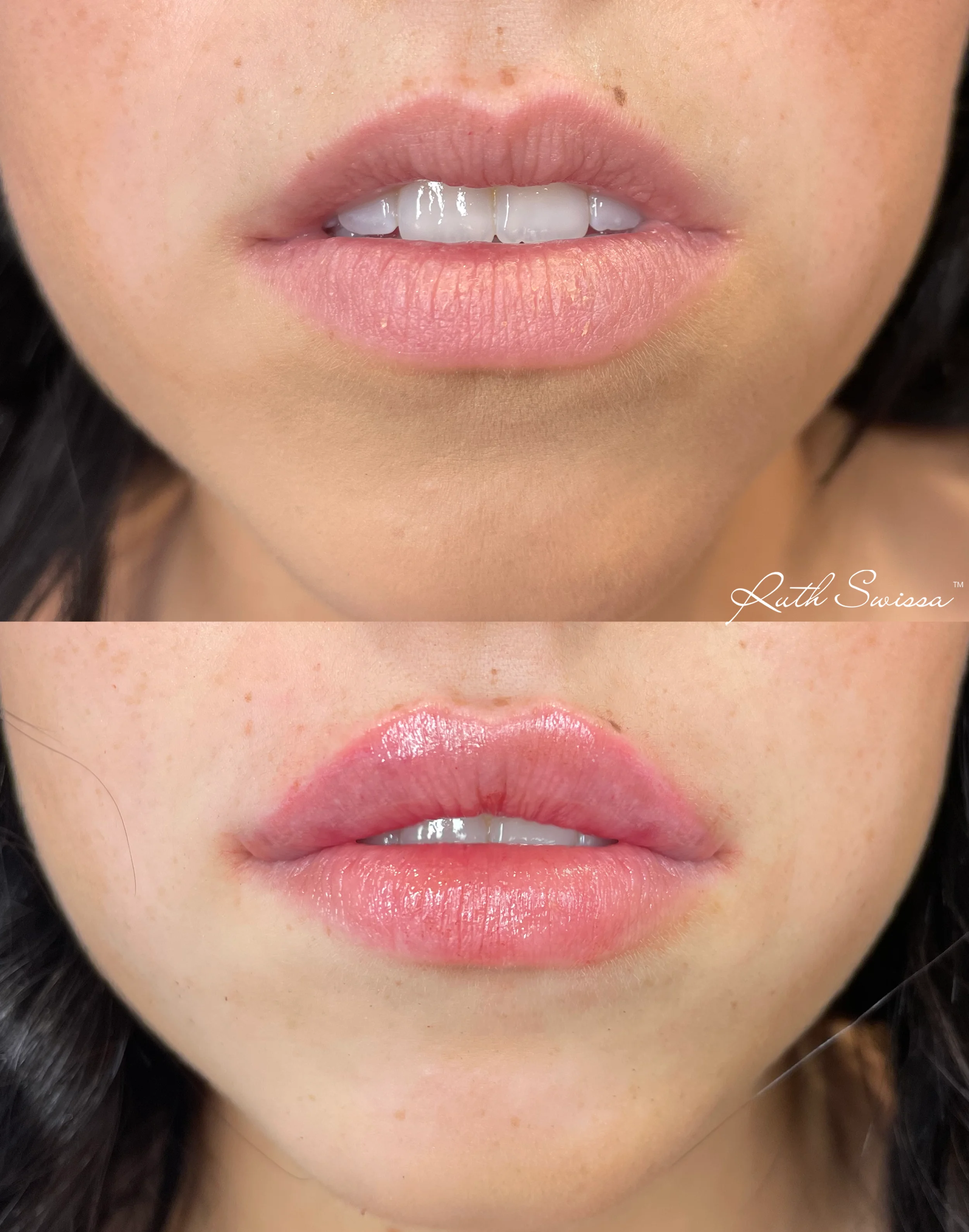 Lip filler
