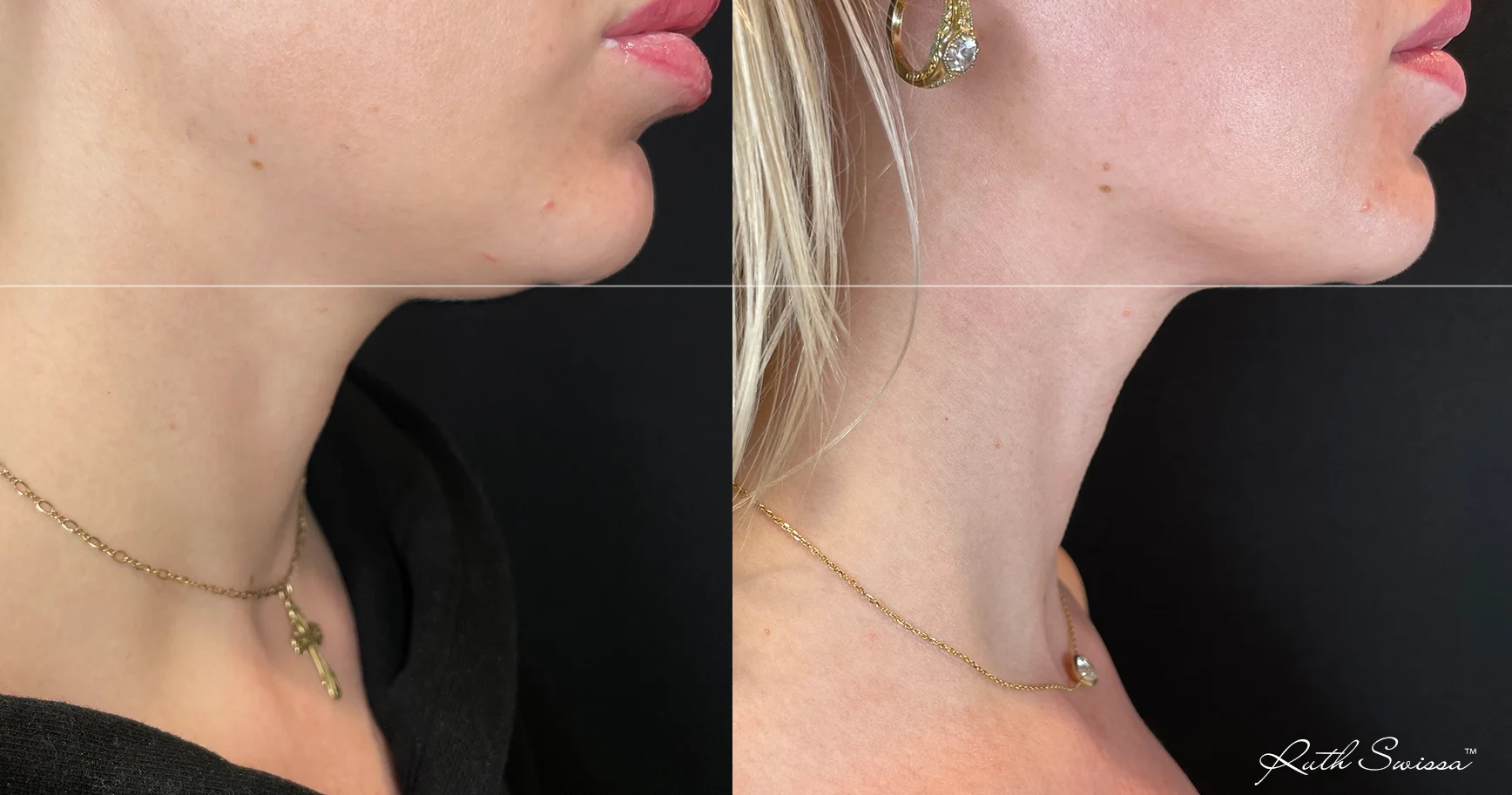 RF microneedling