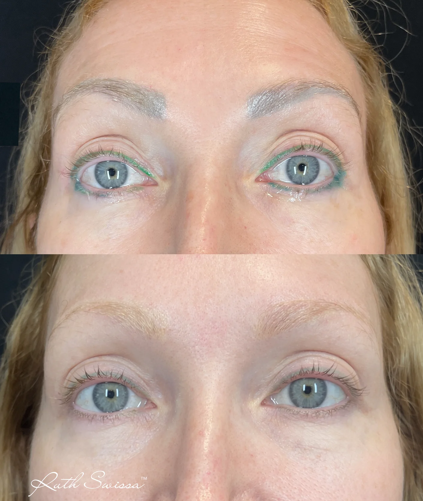 PMU laser removal