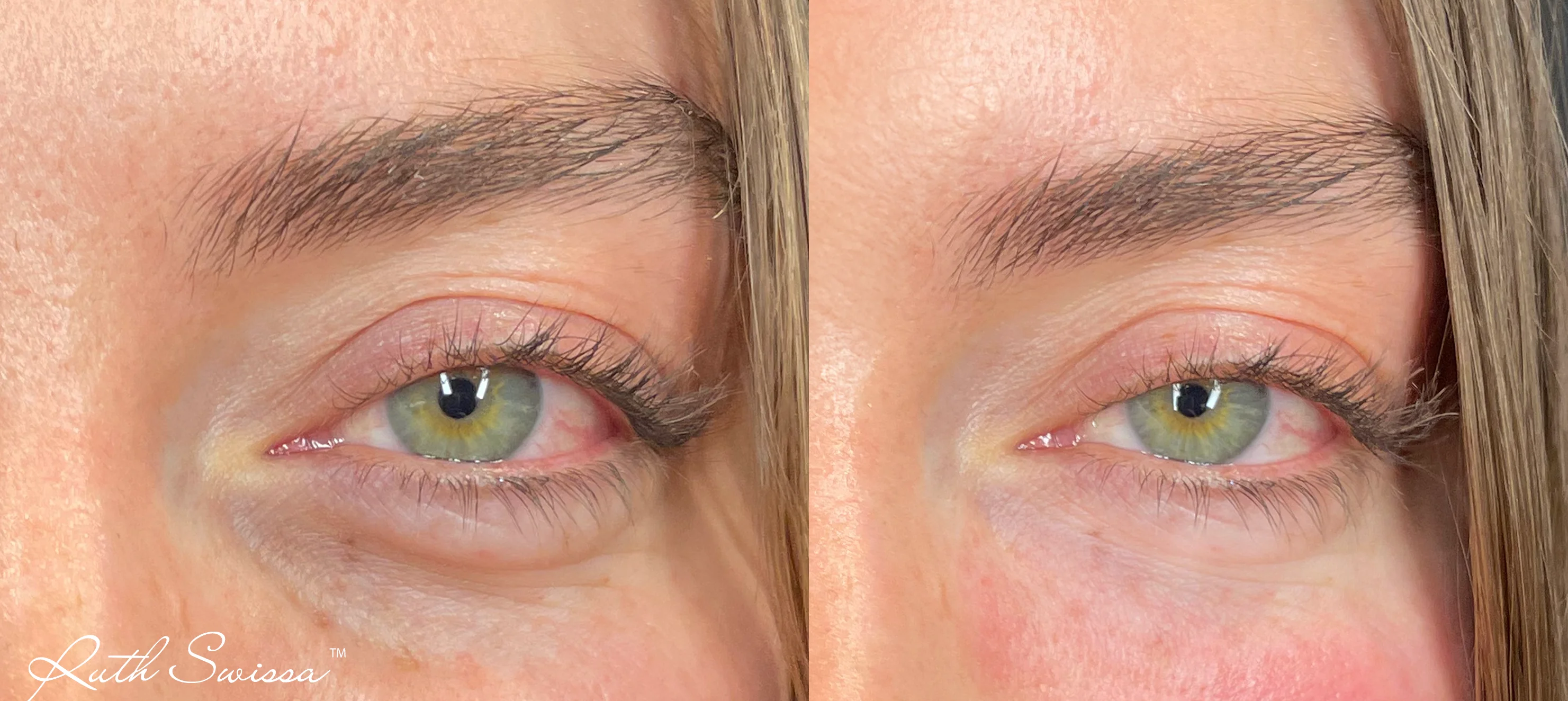 PRF undereye
