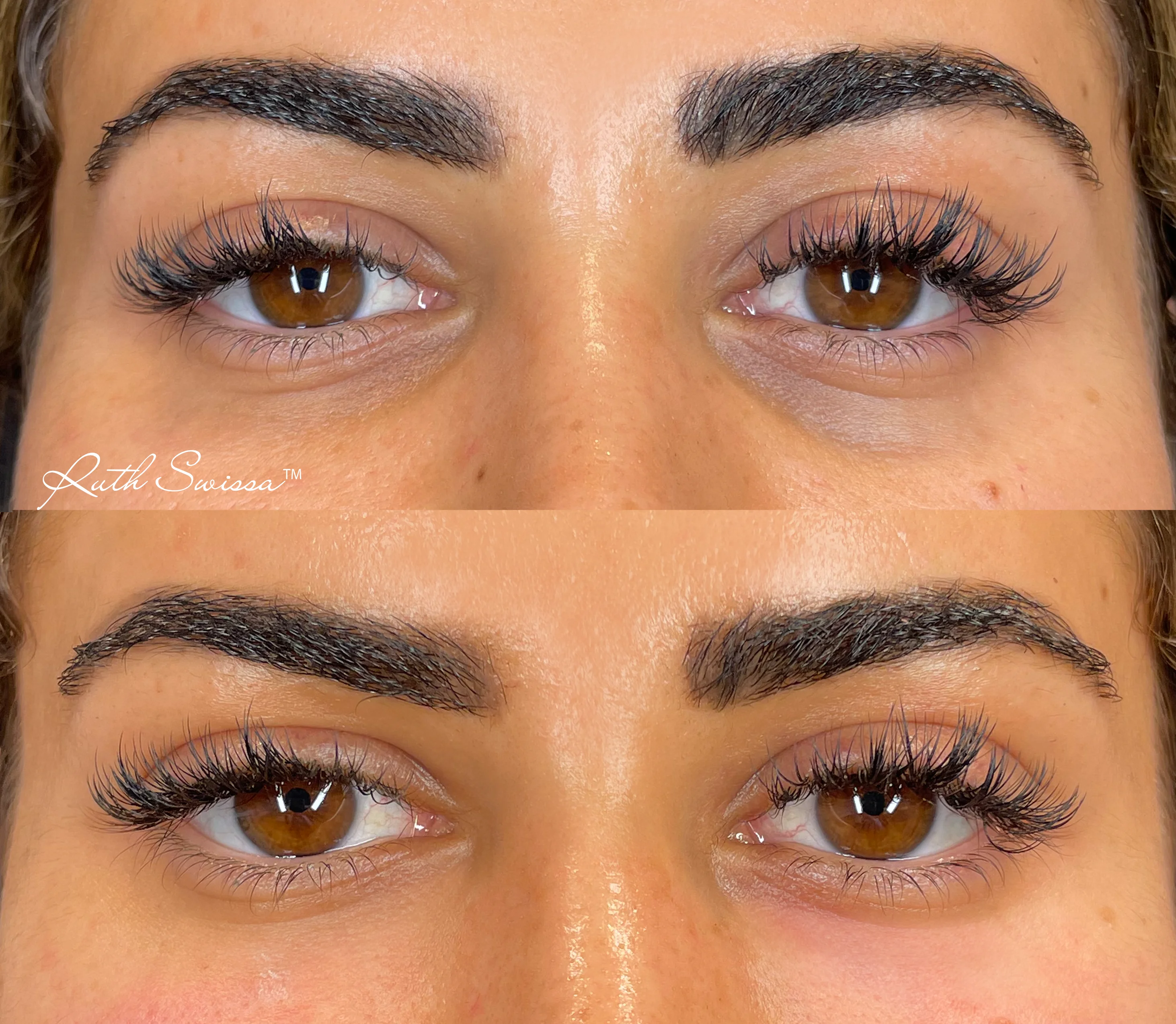 PRF undereye