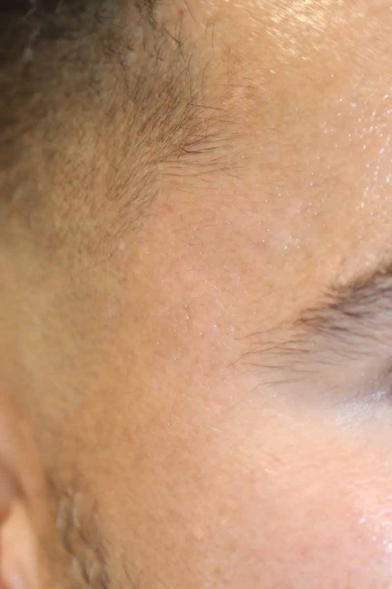 Mature surgical scar · post-camouflage at 8 weeks