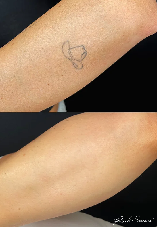 PicoSure