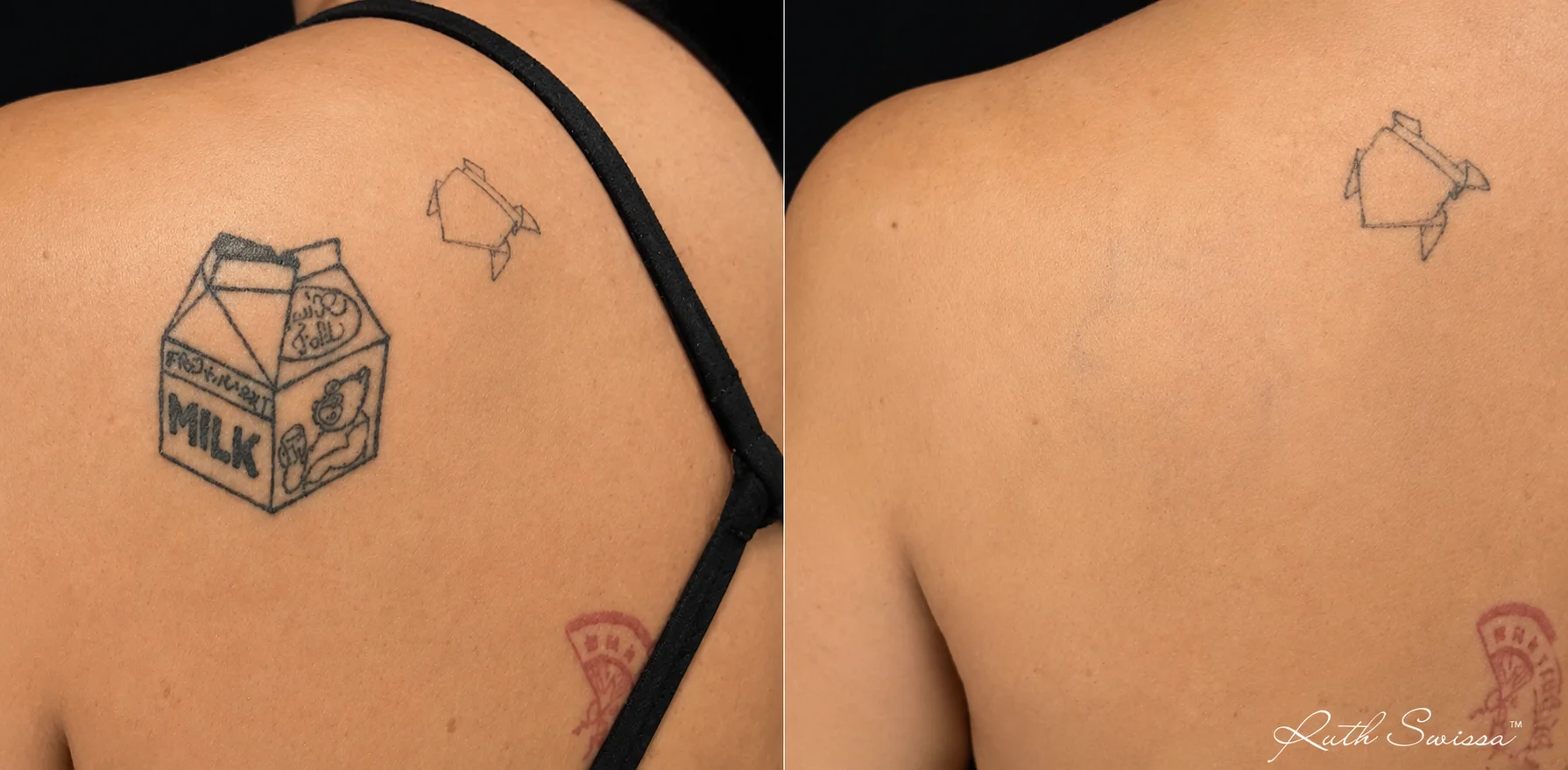PicoSure