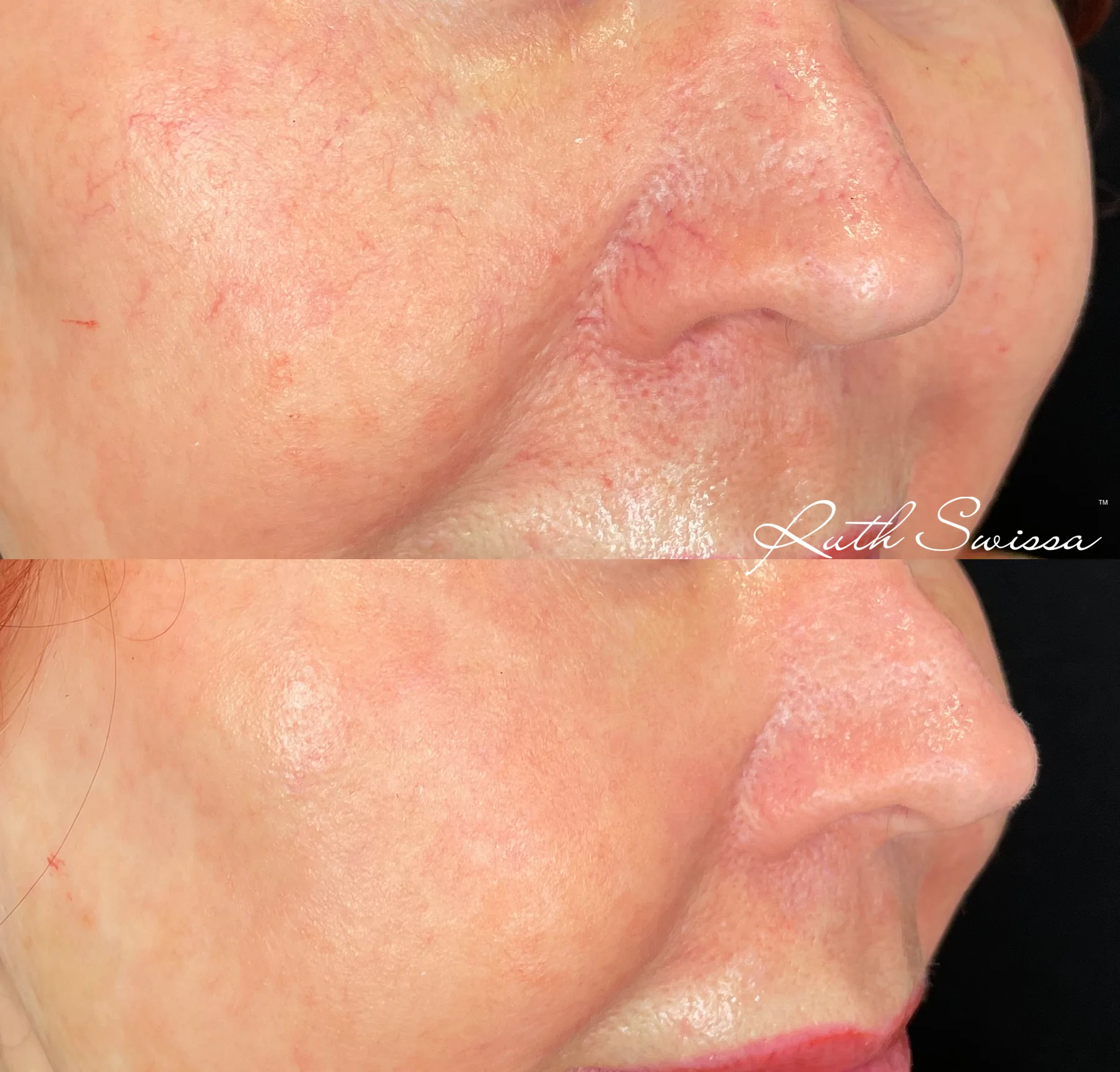 Vascular laser