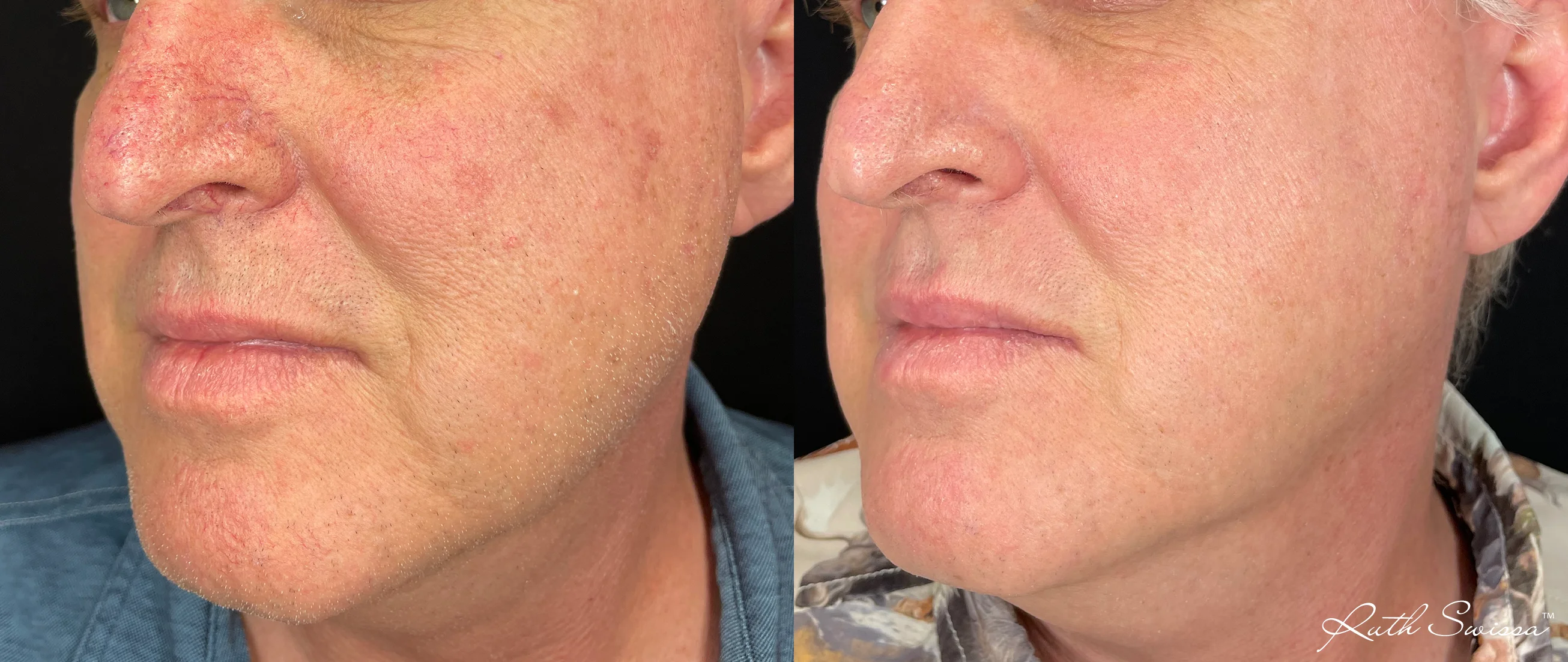 Vascular laser