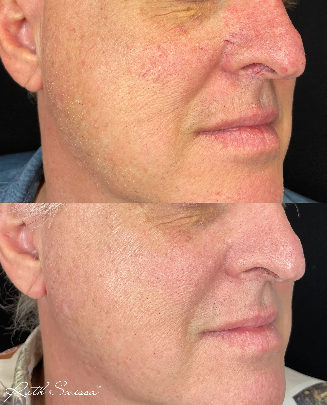 Vascular laser